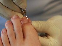 Algunha vez sentiches molestias nos pés ocasionados polas uñas?