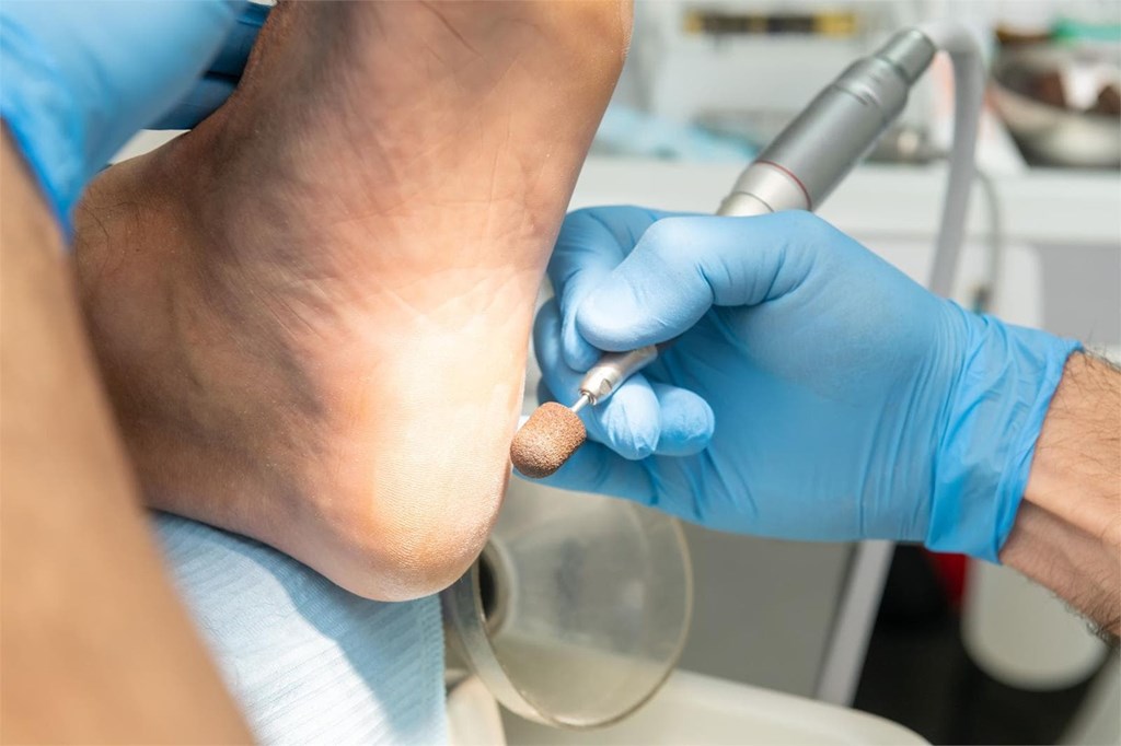 3 consejos para prevenir la aparición de callos y durezas en los pies