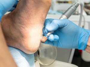 3 consejos para prevenir la aparición de callos y durezas en los pies