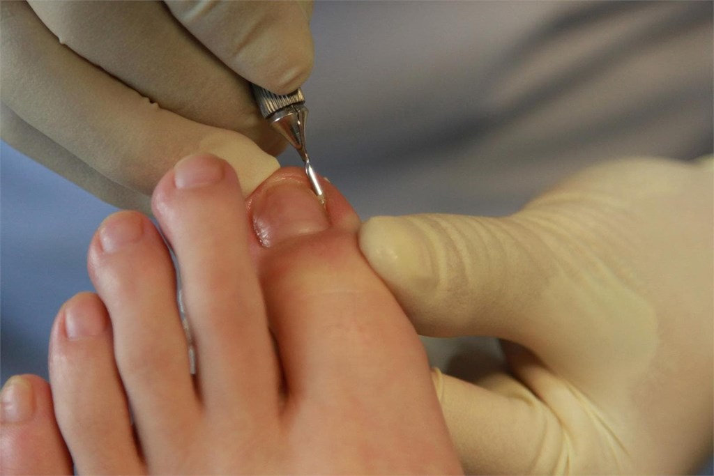 ¿Alguna vez has sentido molestias en los pies causadas por las uñas de los pies?