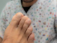 Onicomicosis: cómo prevenirla y tratarla de forma eficaz