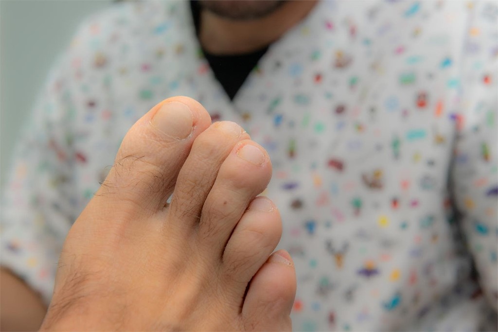 Onicomicosis: como previla e tratarla de forma eficaz
