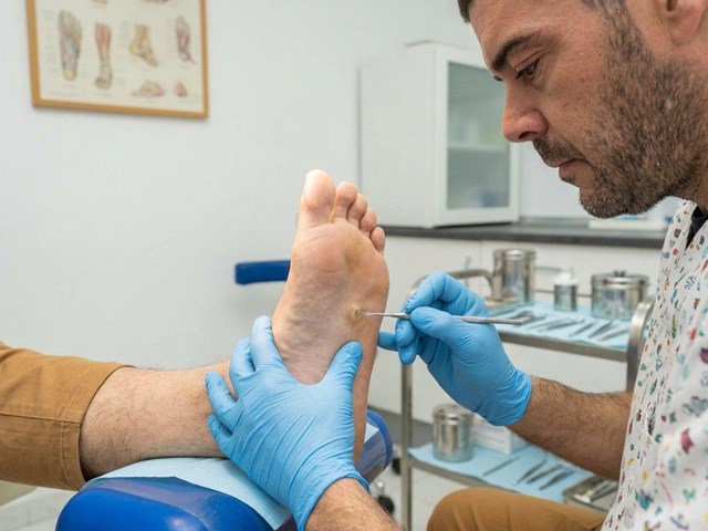 Tratamento de papiloma en Ourense